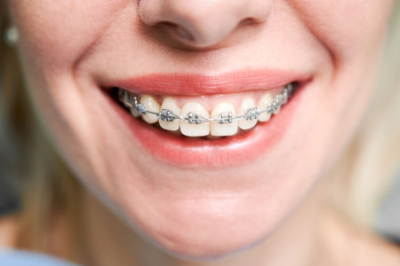 How to choose orthodontic braces