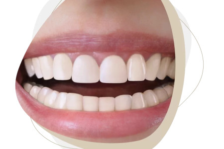 Crooked teeth – causes and treatment of crowded teeth